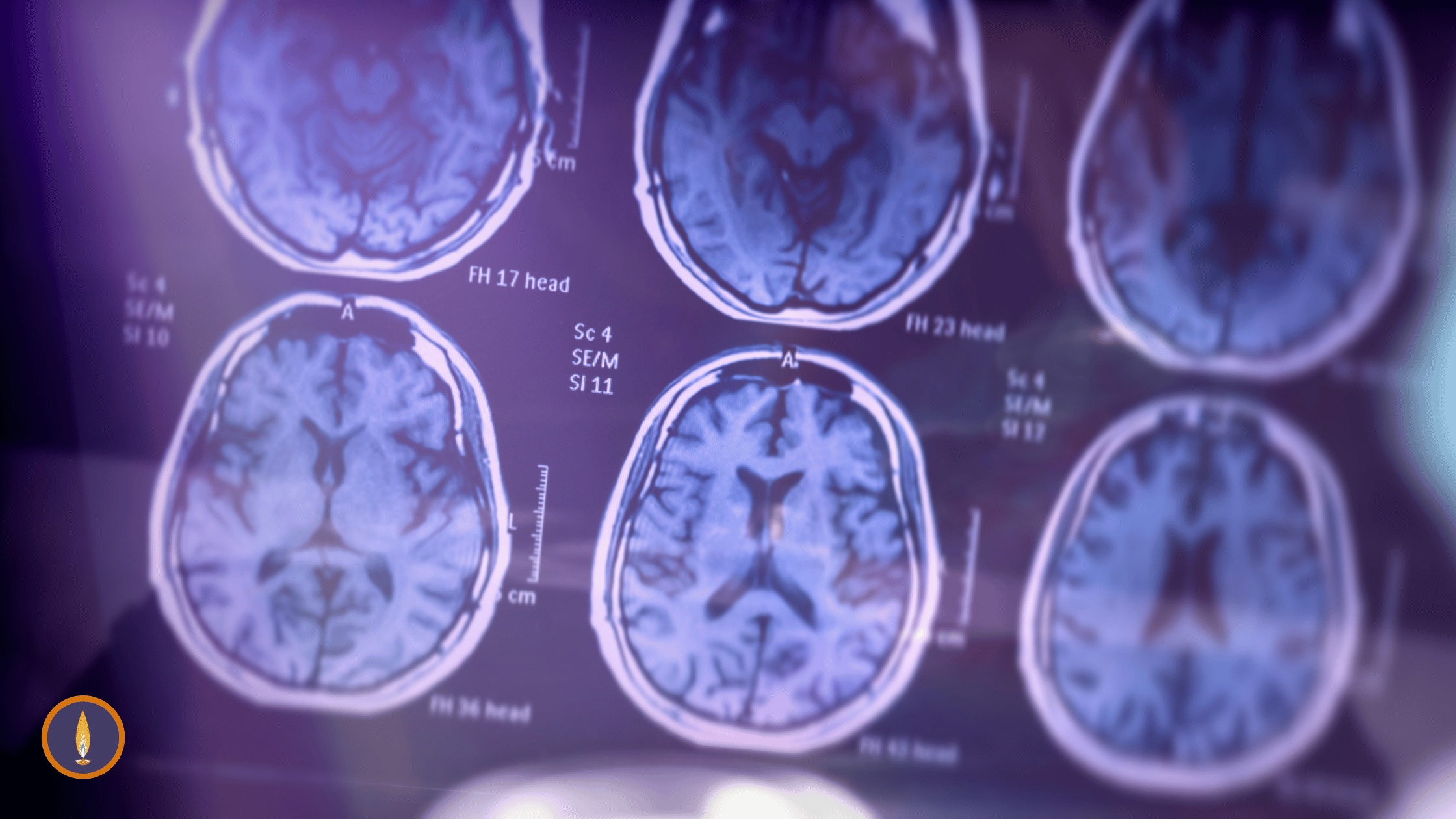 Meditation can Prevent Dementia & Alzheimers